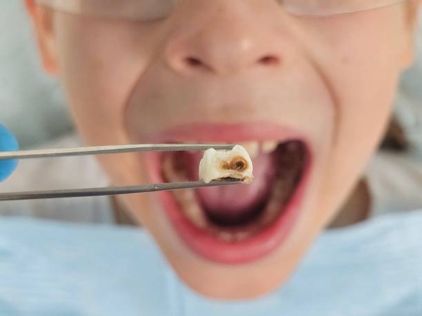 Best Emergency Wisdom Teeth Removal in Allendale, NJ